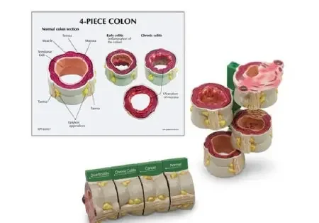 GPI Anatomicals – 4-Piece Colon Model with Pathologies – SB46334