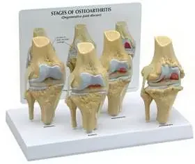 GPI Anatomicals – 4 Stage Osteoarthritis Knee Model – 70573