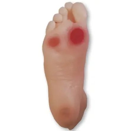 Health Edco – Diabetic Foot Model Set – SB43091