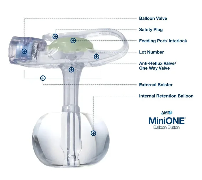 MiniONE – Low Profile Balloon Button Gastrostomy Tube 18 Fr. 4.4 cm Tube Silicone – M1-5-1844-I