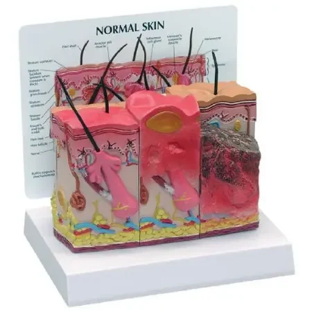 Nasco – Skin Burn Normal Model – SB46482