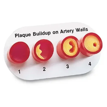 Nasco Healthcare – Artery Sections with Blockage Model – WA09742