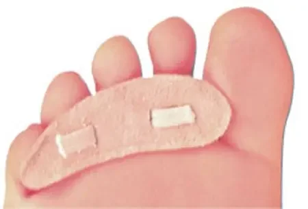 PediFix – Hammer Toe Crest Pedifix Large Without Closure Male 9 / Female 10-1/2 Right Foot – 6209/NA/RL